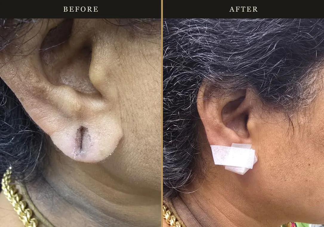 Ear lobe repair treatment — before and after results